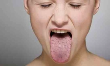 Boğaz Kuruluğu Belirtileri ve Tedavisi Boğaz Kuruluğu Belirtileri ve Tedavisi